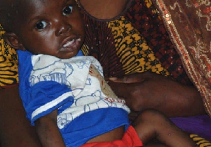 Enfant souffrant de malnutrition au Mali